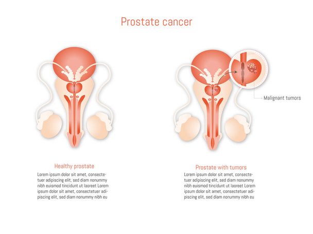 What Causes Prostate Cancer
