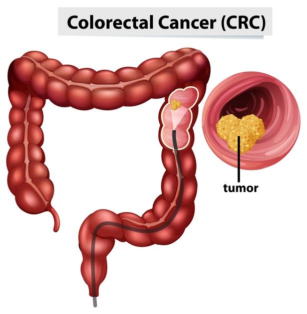 What is Colorectal Cancer?