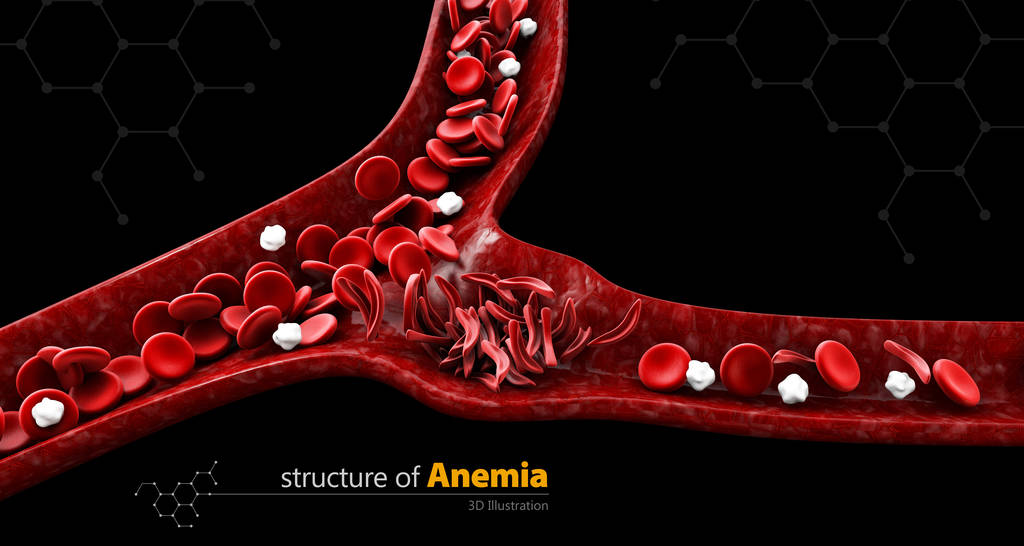 Anemia: What You Need to Know About This Common Blood Disorder
